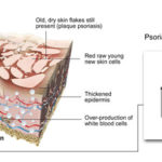 psorijaza1