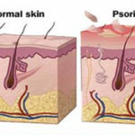psorijaza2