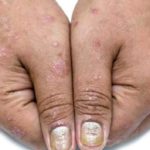 psorijaza3