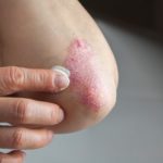 psorijaza4