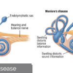 tinnitus-Menieres-disease