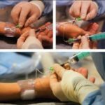 transradijalen-pristap (4)