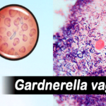vaginalni-infekcii (2)