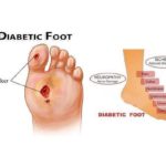 Diabetic Foot Spectrum