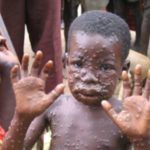 Monkeypox-e1507193787925