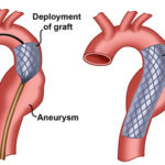 Stent-Placement