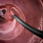 colonoscopy_big