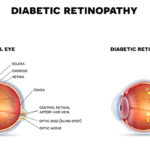 diabeticretinopathy2