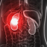 dt_140819_kidney_failure_800x600