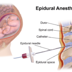 epiduralna1