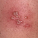 herpes-zoster (2)