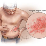 herpes-zoster (4)