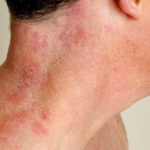 herpes-zoster (5)