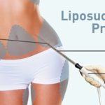 liposukcija