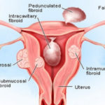 miom-fibroid