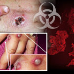 monkeypox-third-case-1023019