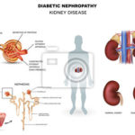 nefropatia-cukrzycowa-choroby-nerek-400-61159093