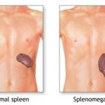splenomegalija (2)