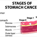 stomach-cancer-types-stages