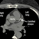 CT1