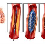STENT1