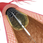 Angioplasty, artwork