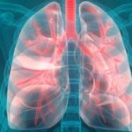lungcancer