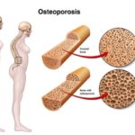 OSTEO1