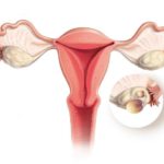 pcos2