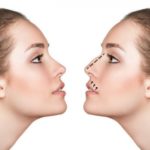 rinoplastia_0