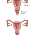 Front view cross section of vagina and uterus, showing thick wall of vagina. Front view cross section of vagina and uterus showing thin, inflamed wall of vagina.