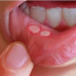 ANEMIJA1