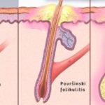FOLIKULITIS