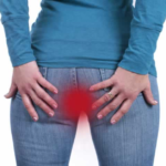 hemorrhoids