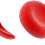 srpesta anemija1