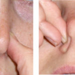 Epistaxis-Image