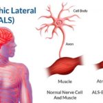 als (1)