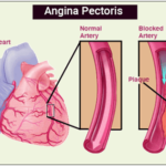 angina