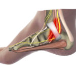 carpal tunel