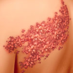 Shingles disease viral infection