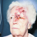 herpes1