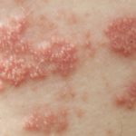 herpes2