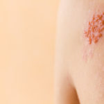 imagen-herpes-zoster