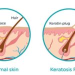 keratosis-pilaris-image