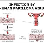 HPV1