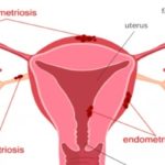 endometrioza2 (1)