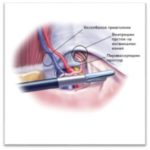 hernija 1