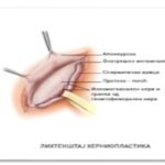 lihtenstaj hernioplastika 1