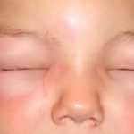 3626-Hereditary_angioedema_eyes-1296×728-slide3