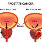 High-fat-diet-linked-to-prostate-cancer-spread_wrbm_large
